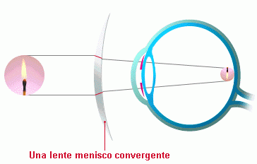 Correccion hipermetropia