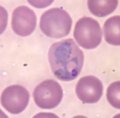 Sangre infectada con Plasmodium